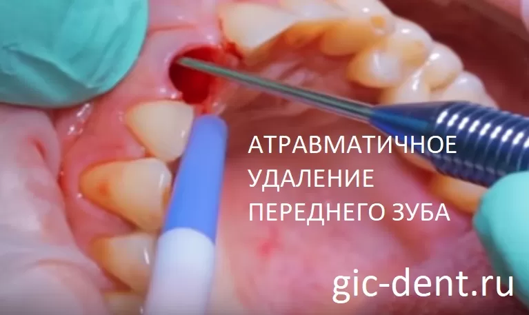 Атравматичное удаление переднего зуба в Немецком имлнпатологическом центре